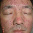 The Myth of Fungal Acne, Microneedling-Caused Scar Tissue, and Fool's Gold: Ask a Skin Care Biologist